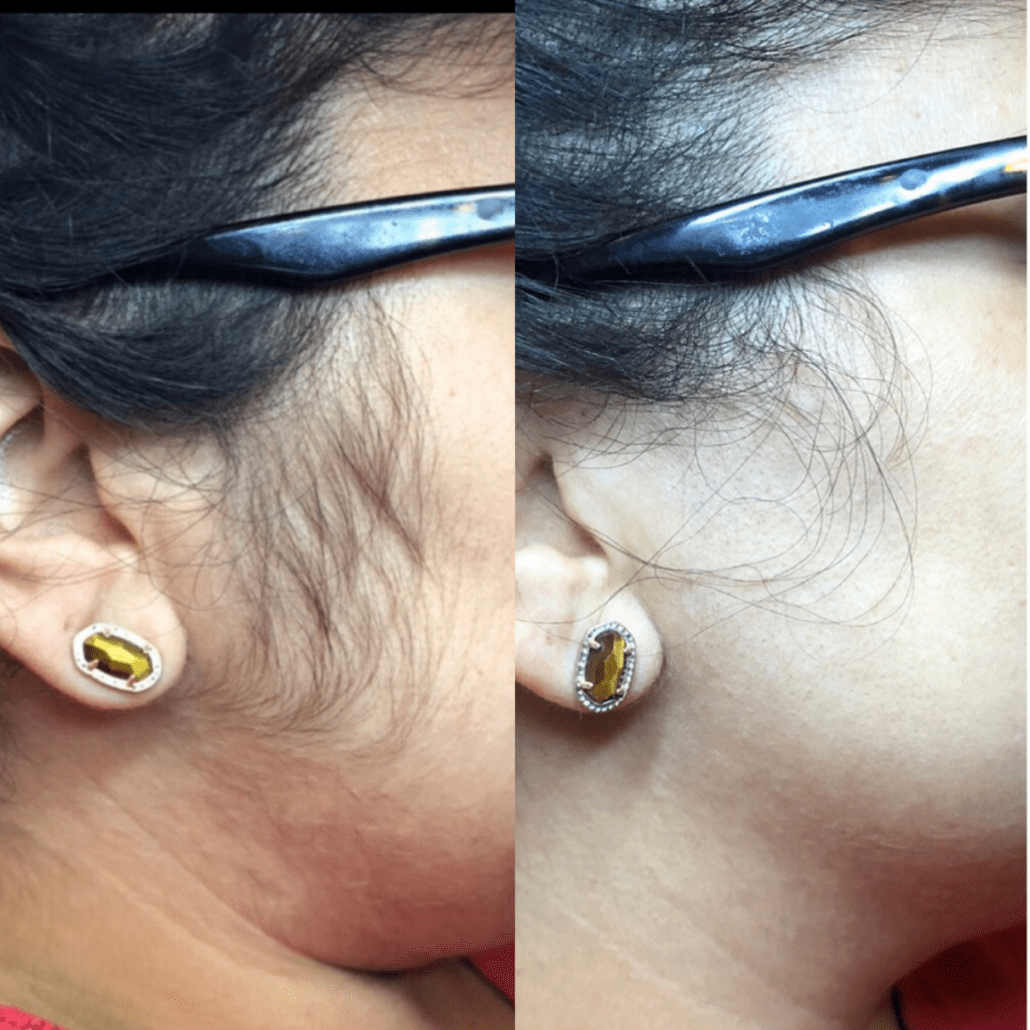 Bella_Visage_Laser_Hair_Removal_2