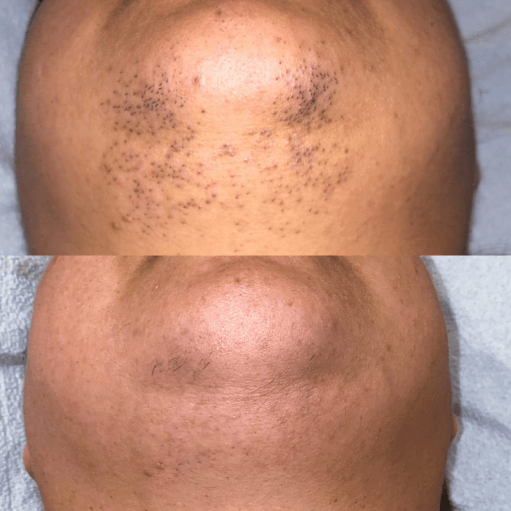 Bella_Visage_Laser_Hair_Removal_3