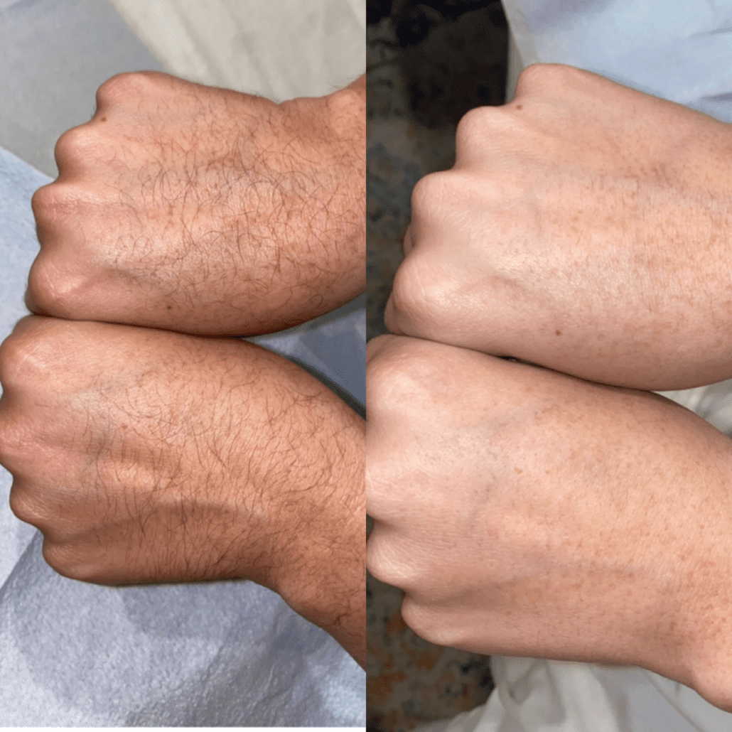 Bella_Visage_Laser_Hair_Removal_4