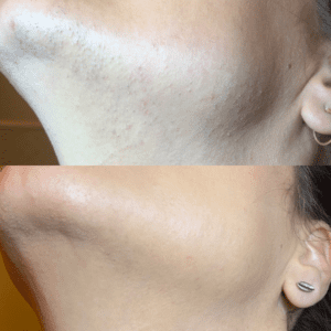 Bella_Visage_Laser_Hair_Removal_5
