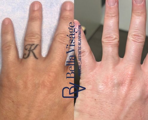 laser-tattoo-removal-bella-3