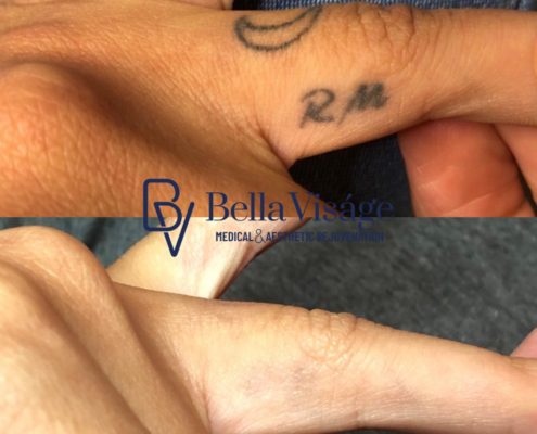 laser-tattoo-removal-bella-4