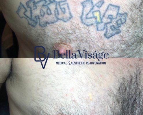 laser-tattoo-removal-bella-thug-life