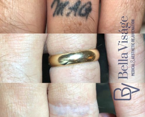 laser-tattoo-bella-12