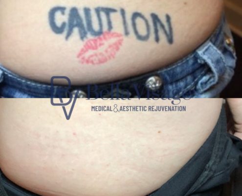 laser-tattoo-bella-14