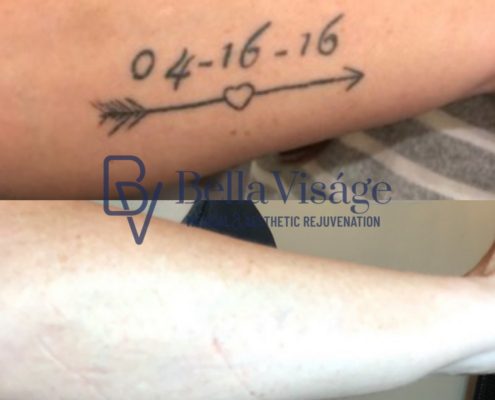 laser-tattoo-bella-15