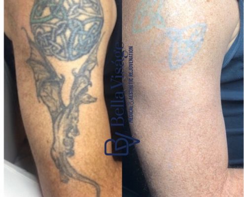 laser-tattoo-bella-5