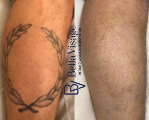 laser-tattoo-bella-7