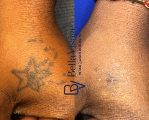 laser-tattoo-bella-8