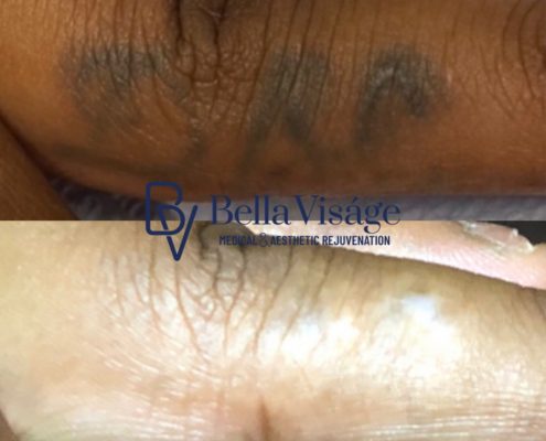 laser-tattoo-bella-9
