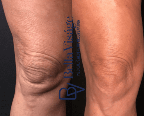 bella-coolpeel-knees-1