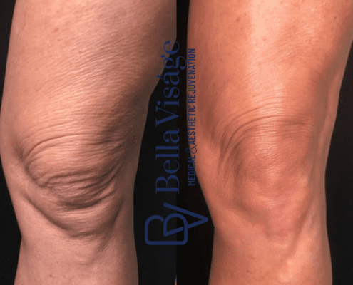 bella-coolpeel-knees-2