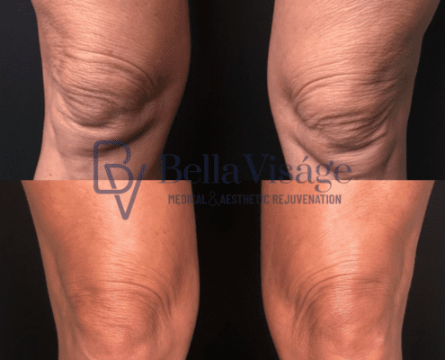 bella-coolpeel-knees-3