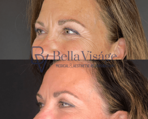 bella-tox-ba-4