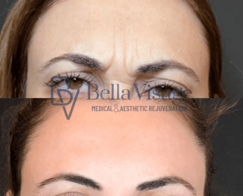 bella-tox-ba-5