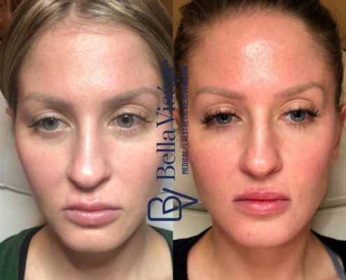 bella-sculptra-ba-1