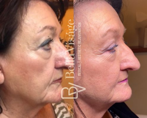 bella-sculptra-ba-2