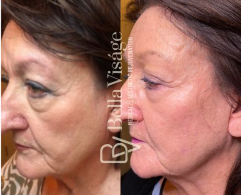 bella-sculptra-ba-3