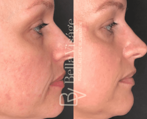 coolpeel4