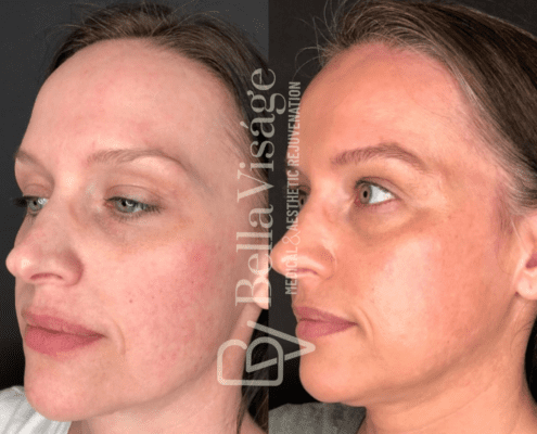 coolpeel5