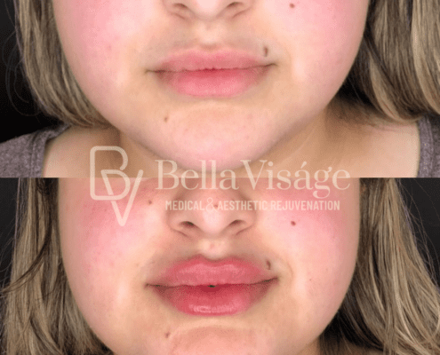dermalfiller1