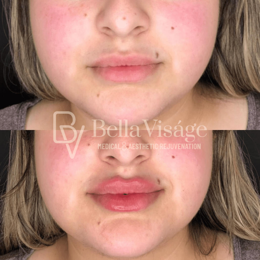dermalfiller1