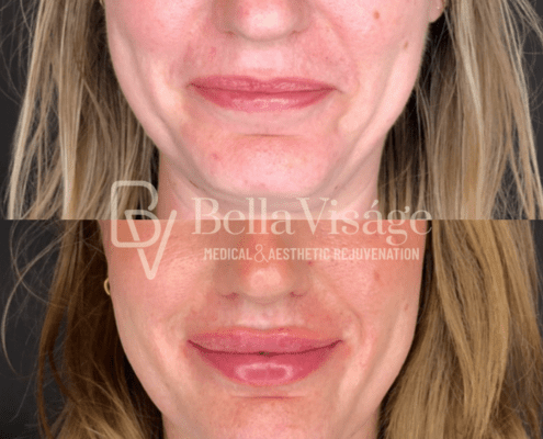 dermalfiller2