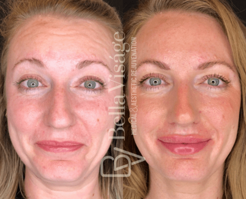 dermalfiller3