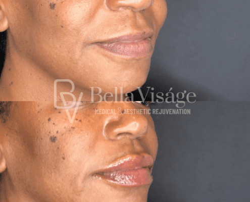 dermalfiller4