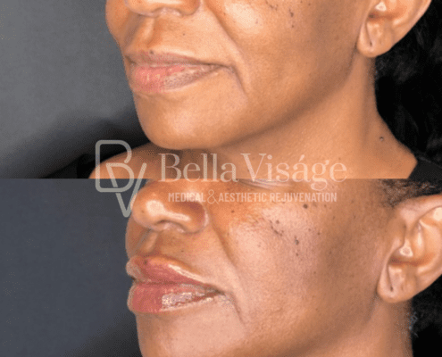 dermalfiller5