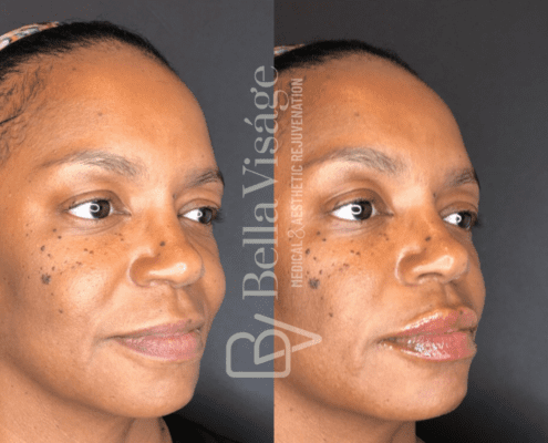 dermalfiller6
