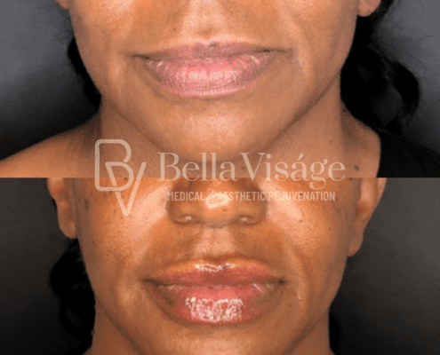 dermalfiller7