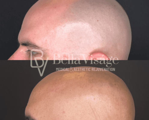 laserhair-head-1
