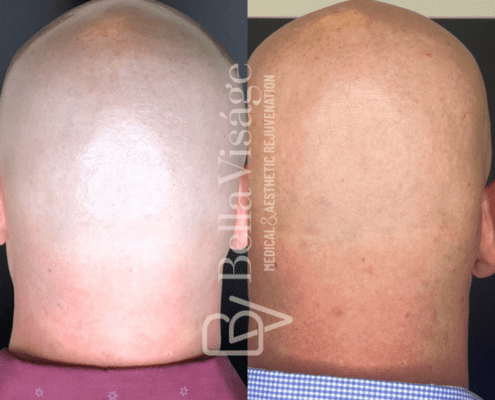 laserhair-head-2