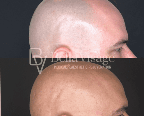 laserhair-head-4