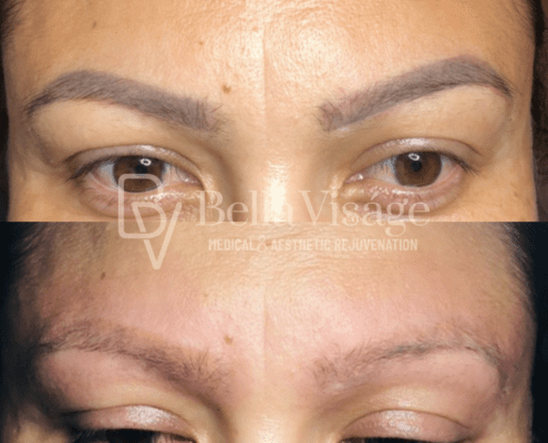 tattooremoval-1