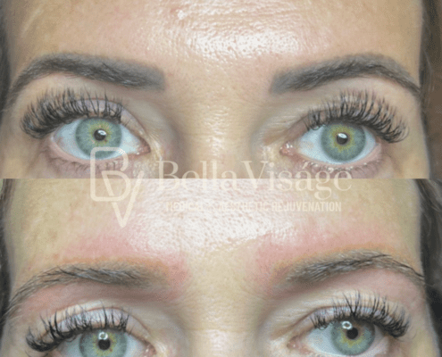 tattooremoval-2