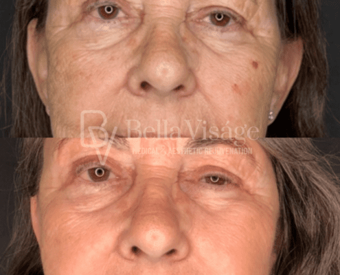 coolpeel10