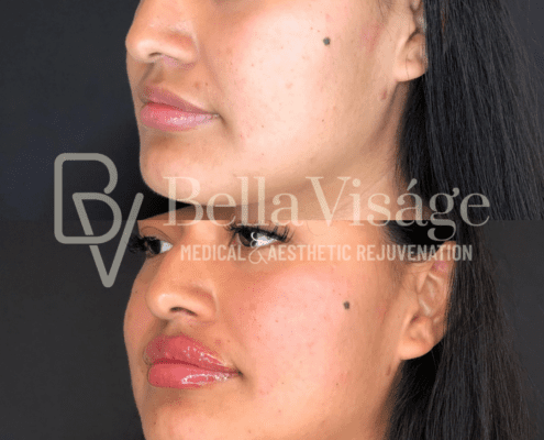 lipfiller10