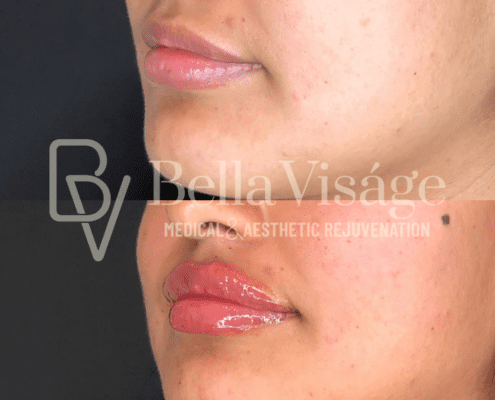lipfiller11