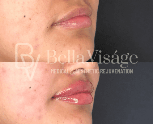 lipfiller12