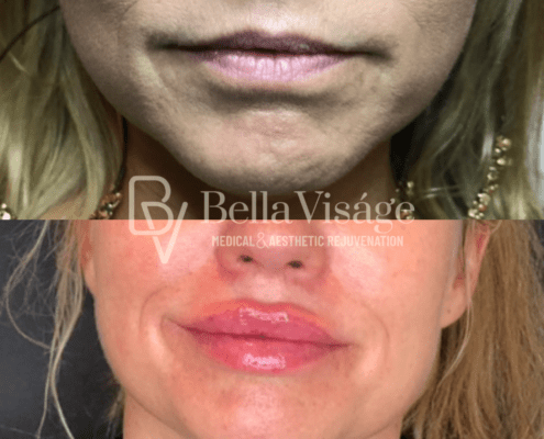 lipfiller14