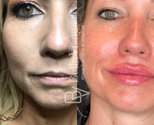 lipfiller15