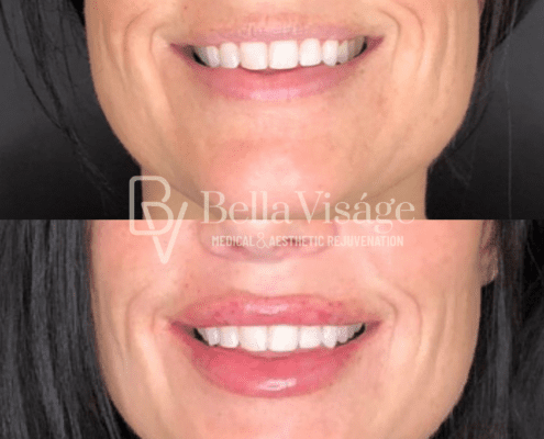 lipfiller16