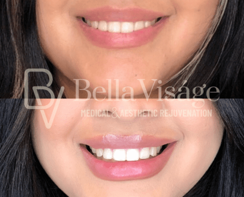 lipfiller7