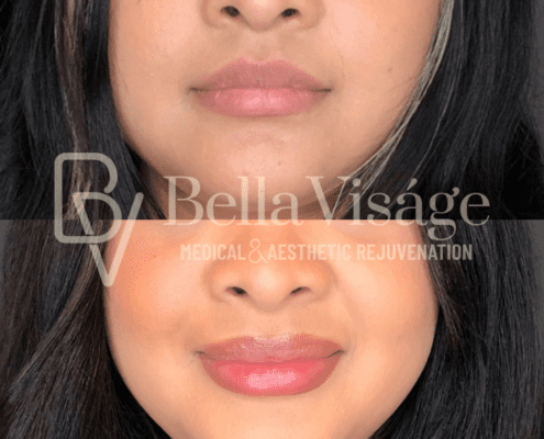 lipfiller8