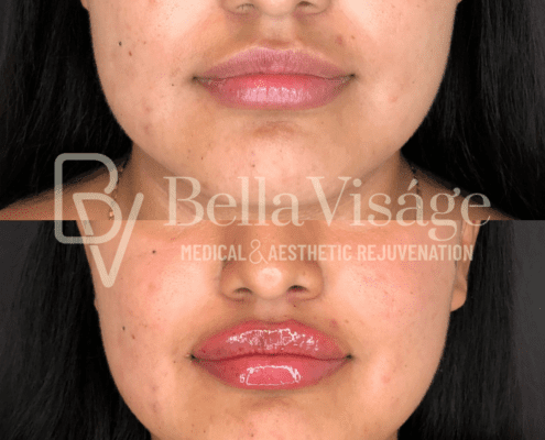 lipfiller9
