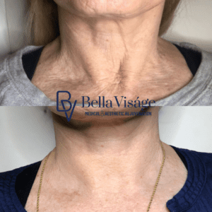 BV CoolPeel Demo 4