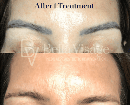 Microblading Removal After 1 Treatment-min