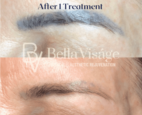 Microblading Removal After 1 Treatment_1-min